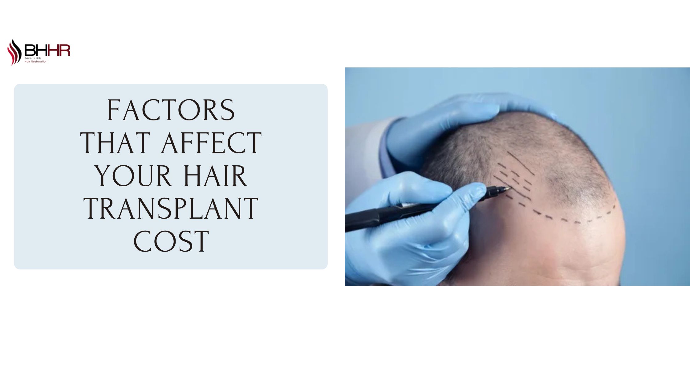 Factors That Affect Your Hair Transplant Cost