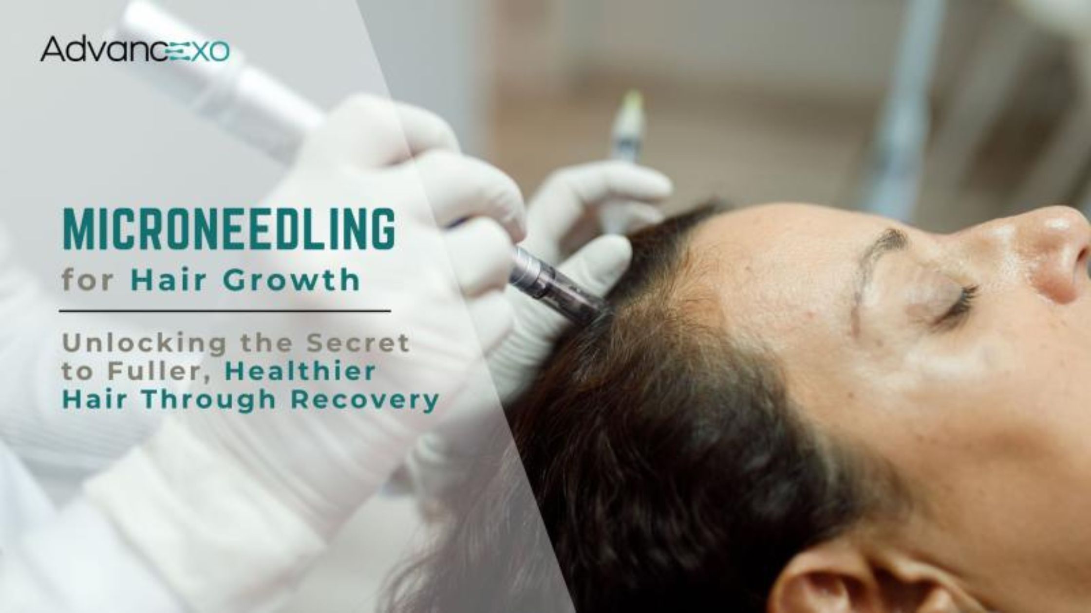 Microneedling for Hair Growth: Unlock Secret to Healthy Hair