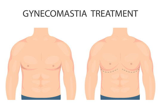 Why Is Gynecomastia Reduction Growing Popular Among Young Men?