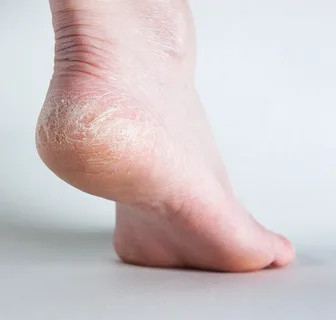 How Podiatry in Edinburgh Helps Manage Dry or Hard Skin