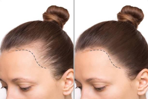 Hair Restoration Tourism: Why Riyadh is Becoming a Global Destination for Transplants