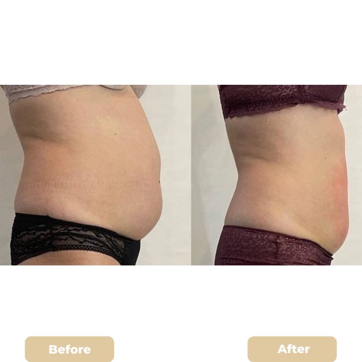 Liposuction: A Complete Guide to Body Contouring