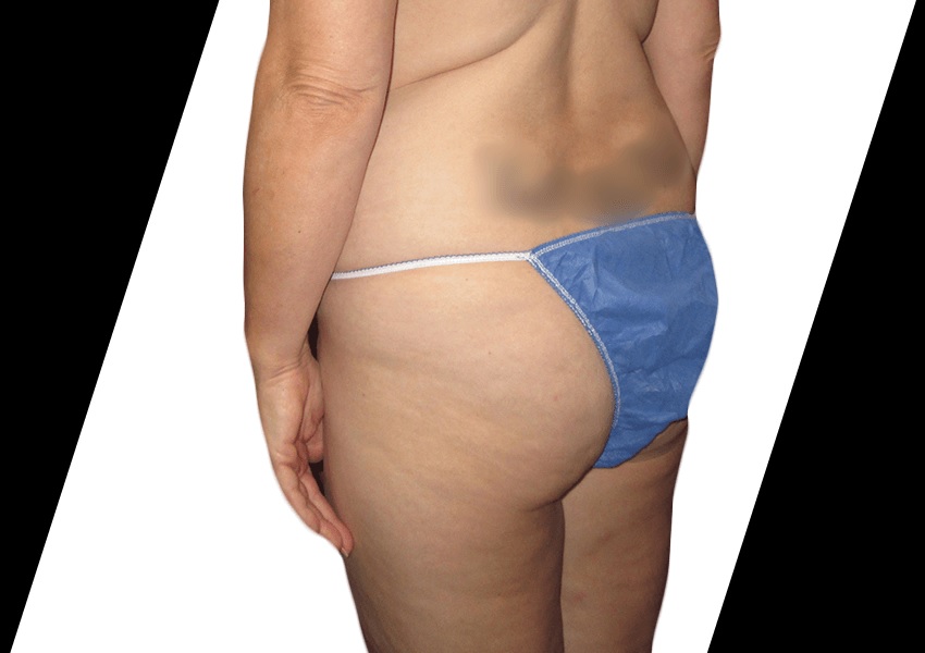 How Can You Prepare for Thigh Lift Surgery in Houston, Texas?