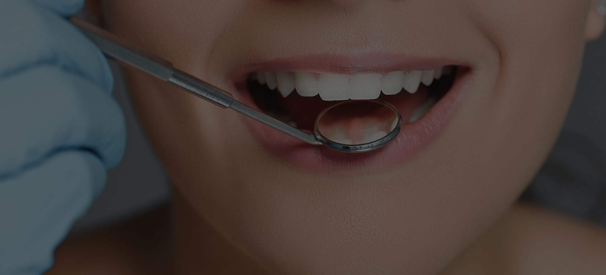 Veneers