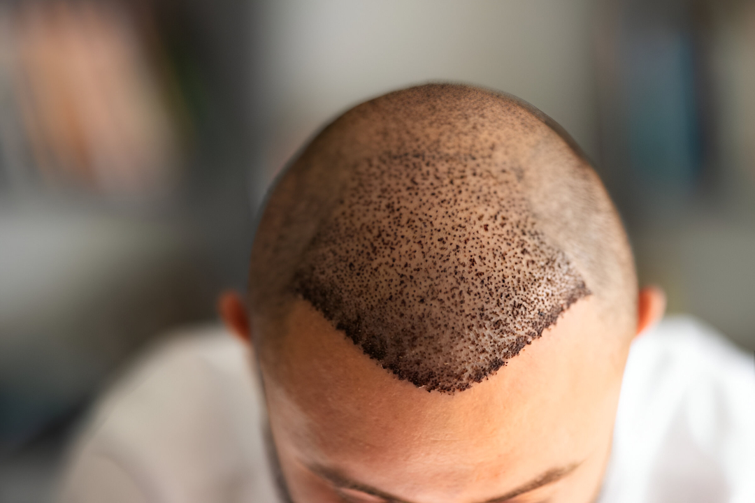Hair Transplant in Islamabad: A Confidence-Boosting Solution