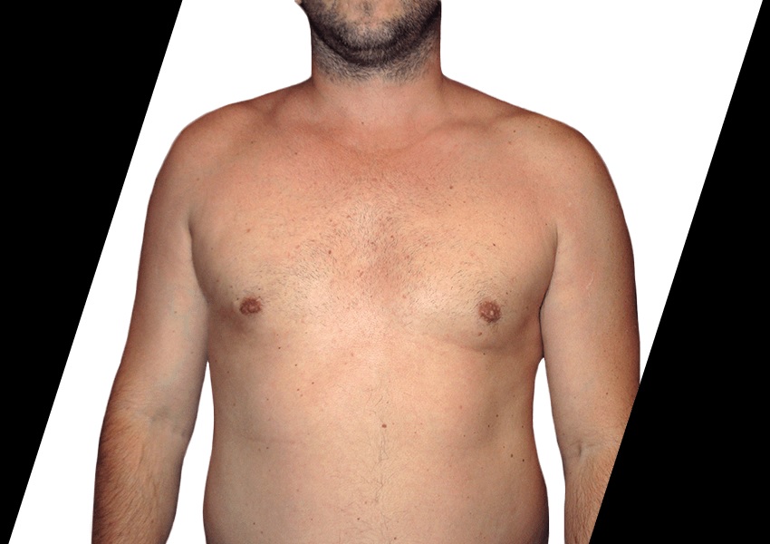 How Long Is the Recovery After AB Etching Surgery in Houston?