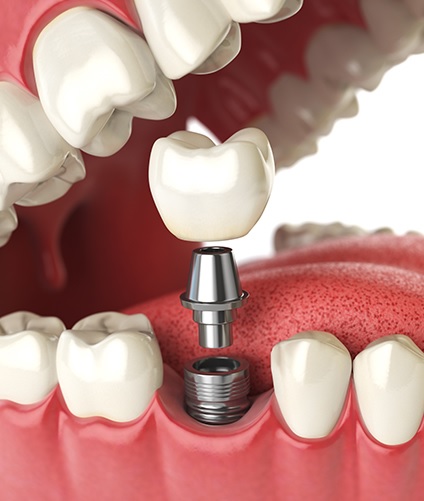Are Discount Dentures a Good Option for Tooth Replacement?