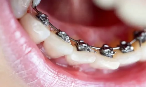 How Do You Choose the Best Dentist for Braces Near You?