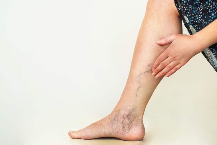 Varicose Veins Doctor