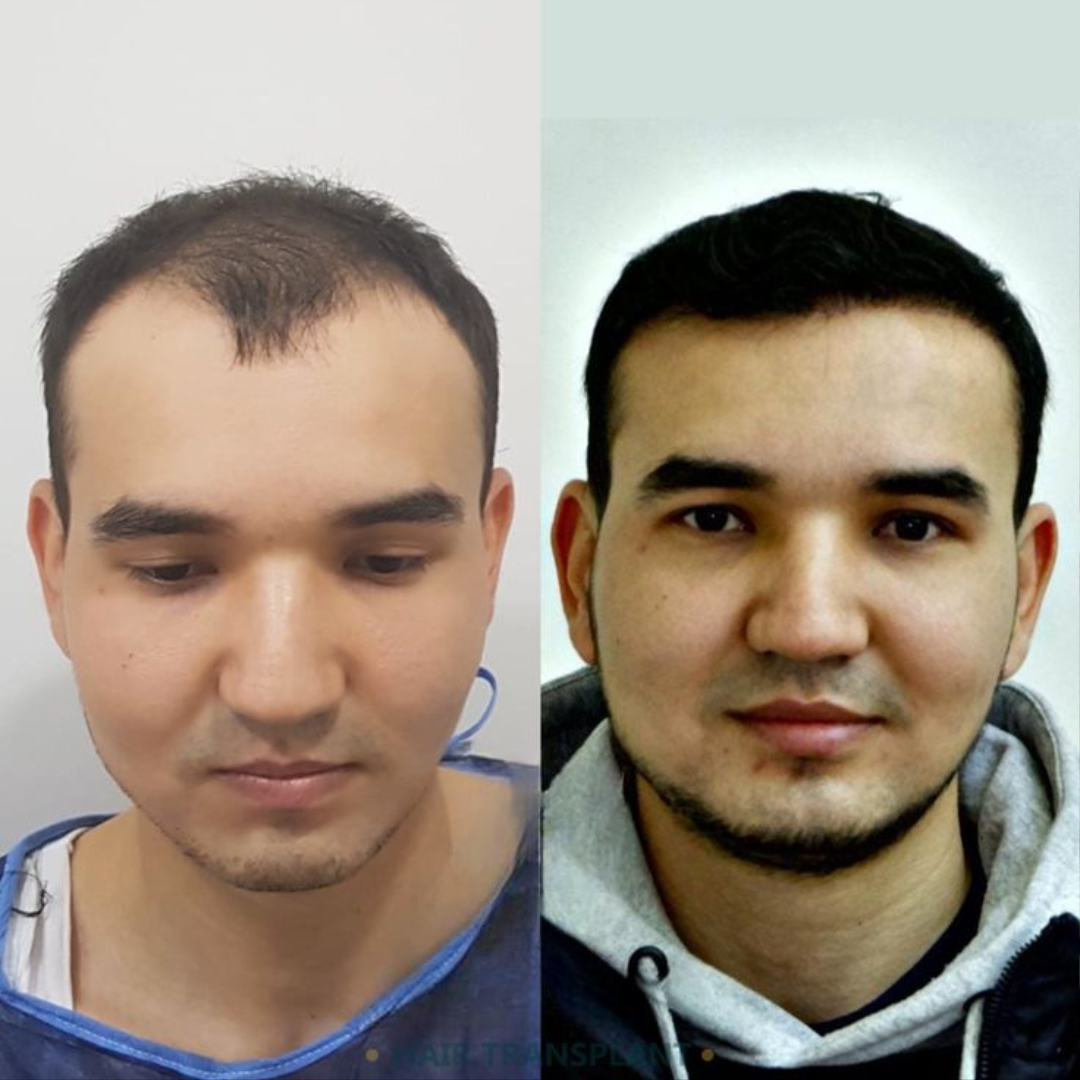 Top Surgeons Performing FUE Hair Transplant in Islamabad