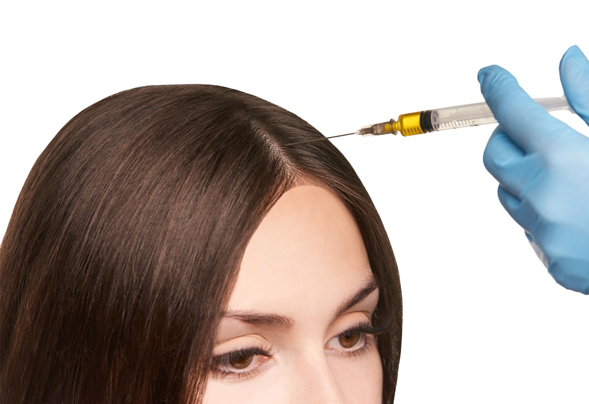 Exosomes for Hair Loss in Islamabad: A Breakthrough in Regenerative Hair Therapy