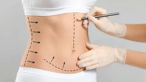 Tummy Tuck in Islamabad for Excess Fat and Skin