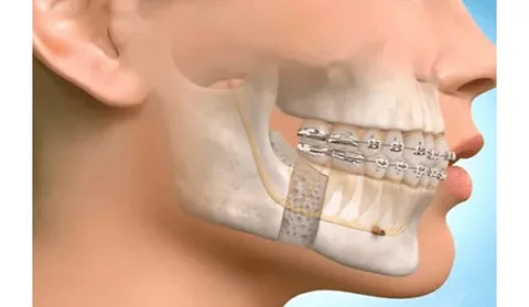 Jaw Surgery in Islamabad – Risks, Benefits, and Recovery