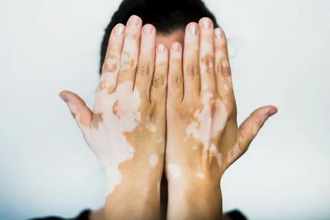 Modern Skin Therapies for Vitiligo Treatment in Islamabad