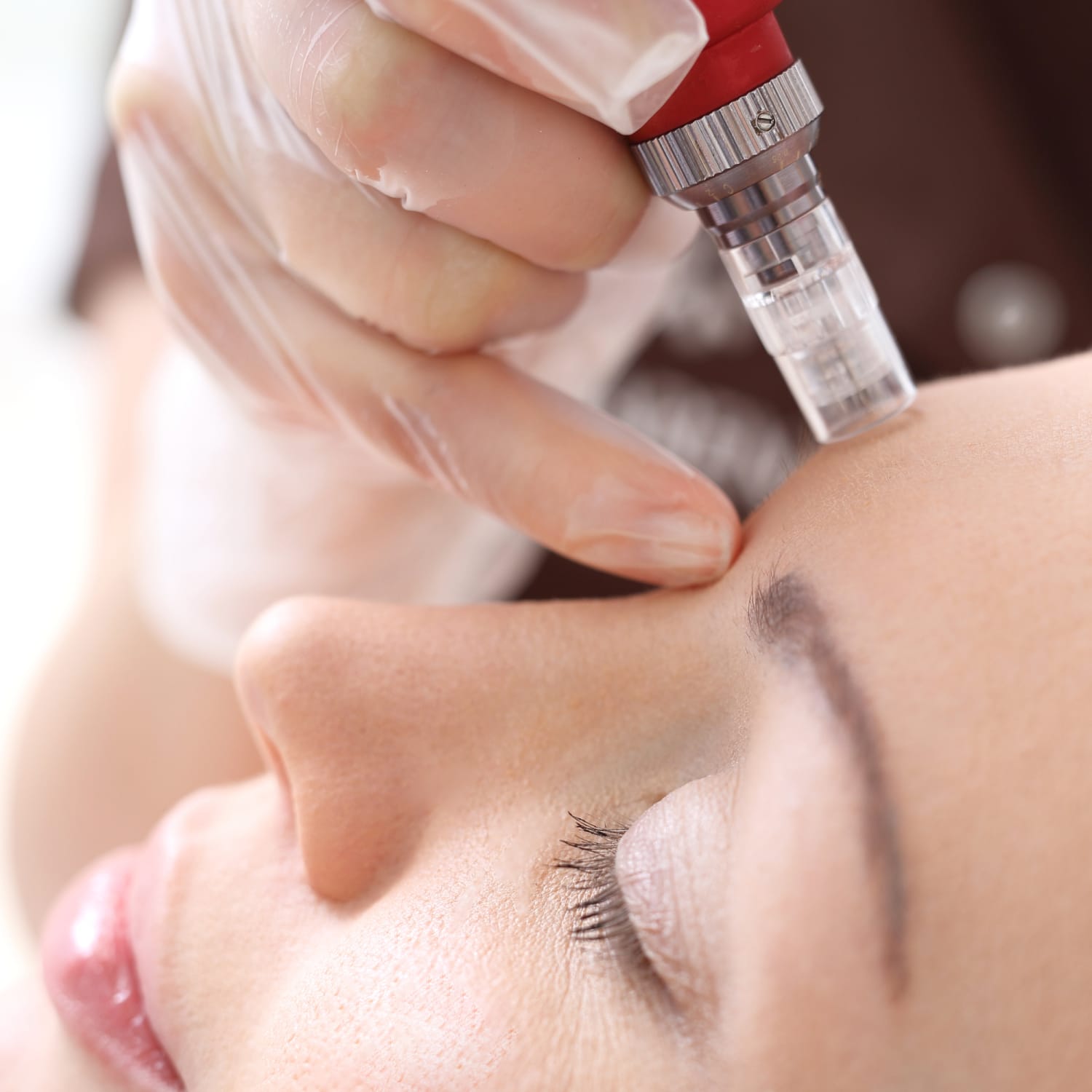 Microneedling Treatment Cost Guide for First-Timers
