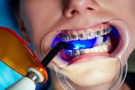 braces north miami beach
