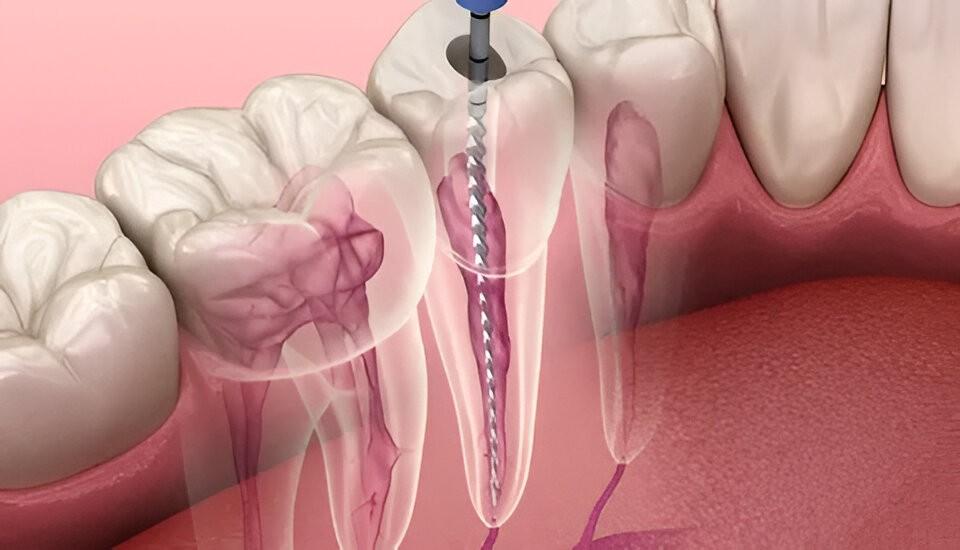 Root Canal Treatment in Islamabad – Quick Recovery