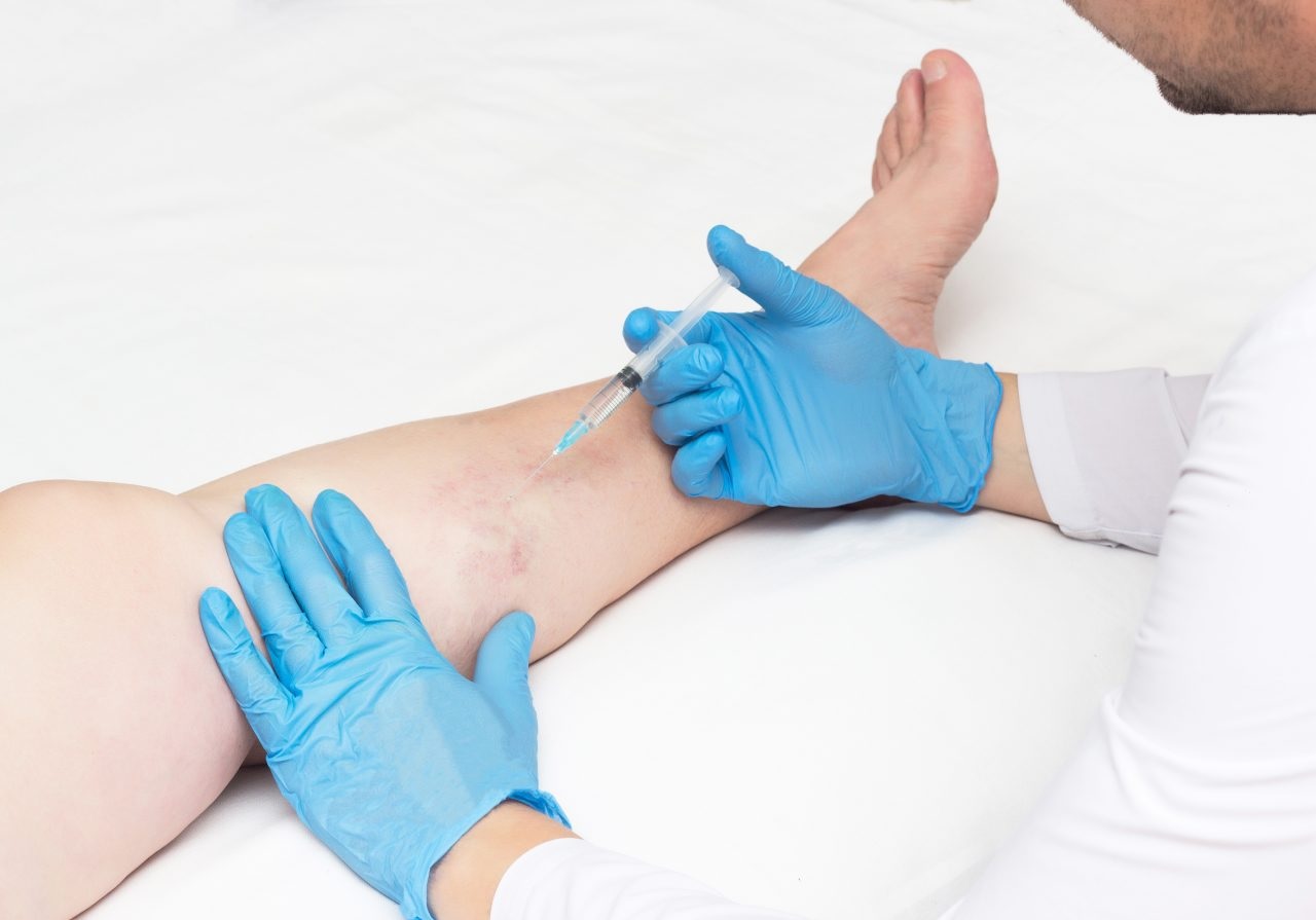 What Treatment Options Are Available at a Vein Clinic?