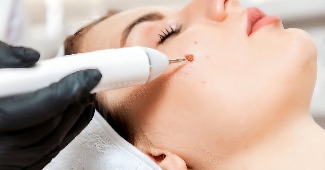 Say Goodbye to Warts – Islamabad Safe Removal