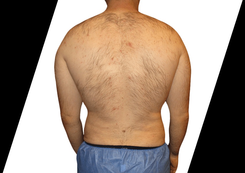 body contouring after weight loss houston