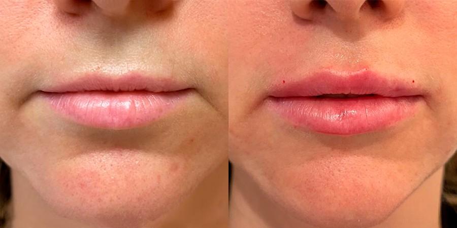 Lip Augmentation in Islamabad for Perfect Symmetry