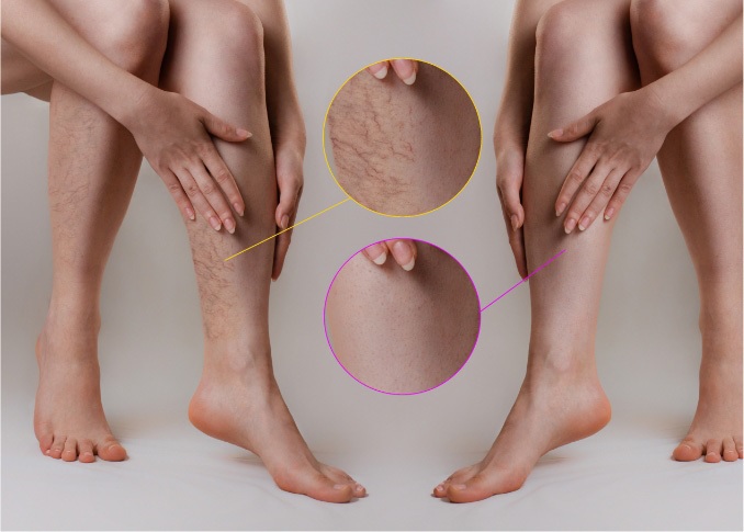 What Causes Varicose and Spider Veins, and How Are They Treated?