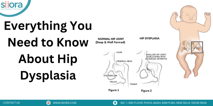 Everything You Need to Know About Hip Dysplasia
