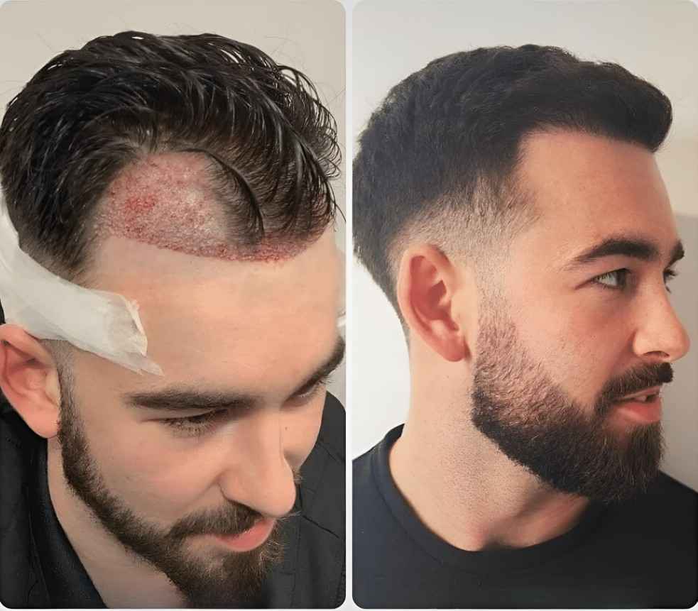 Expert Tips for Hair Transplant in Islamabad