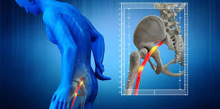 Sciatica Treatment in St. Louis: Real Solutions for Lasting Nerve Pain Relief