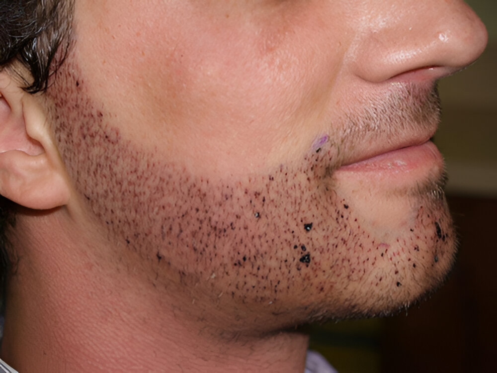 Beard Hair Transplant in Islamabad: Everything Explained