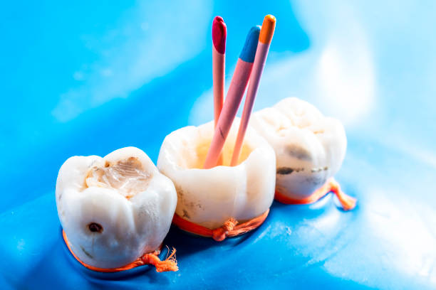 A Comprehensive Guide to Preserving Your Teeth Root Canal Treatment in Islamabad: