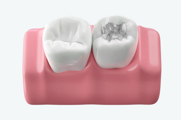 Keep Teeth Strong and Cavity-Free Dental Fillings in Islamabad: