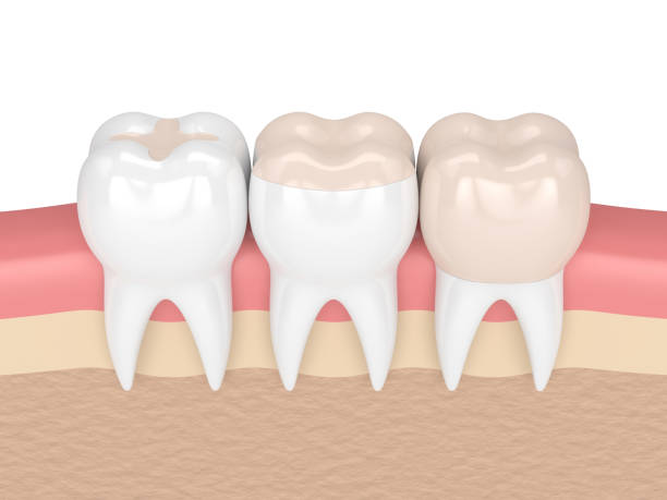 Complete Dental Filling Guide for Long-Lasting Oral Health in Islamabad
