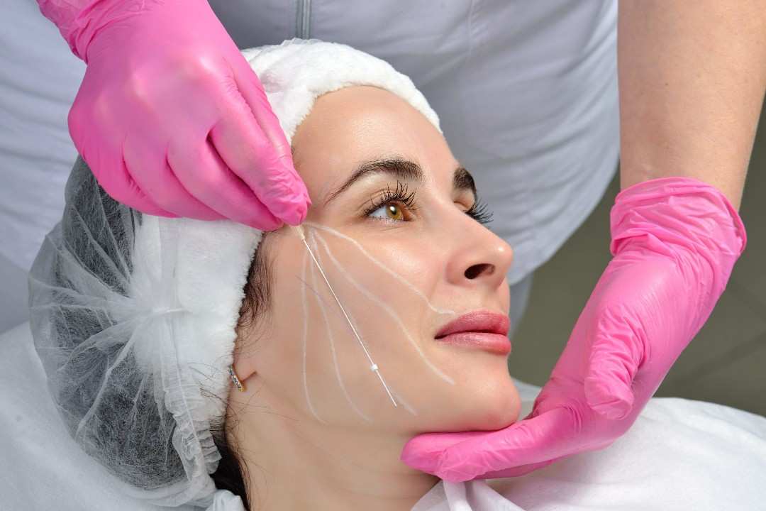 Thread Lift in Islamabad: Facelift Without Pain