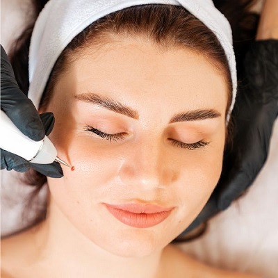 Gentle Dermatology Treatments for Skin Moles