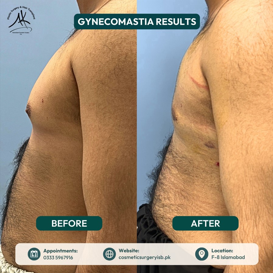 Family Guide: Supporting Loved Ones with Gynecomastia in Islamabad