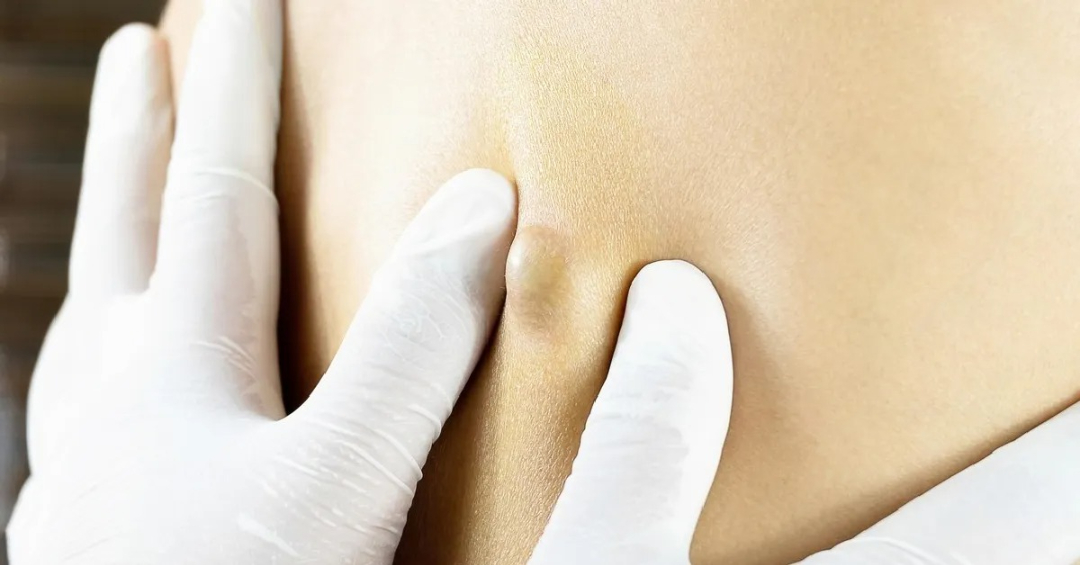 Safe Lipoma Treatment in Islamabad – Smooth Results