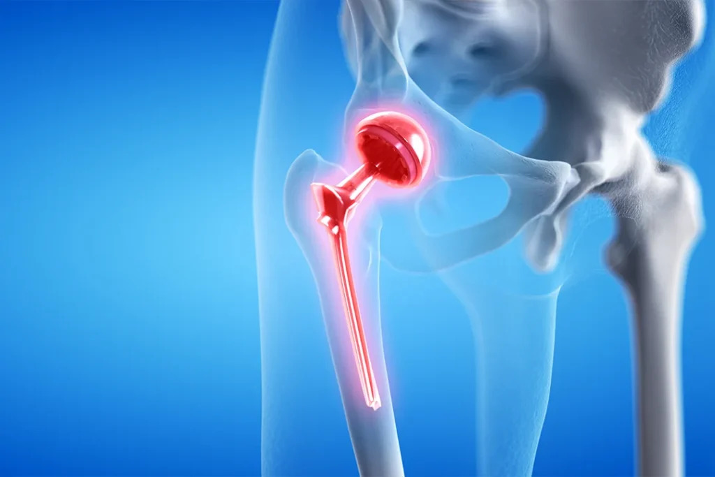hip replacement last