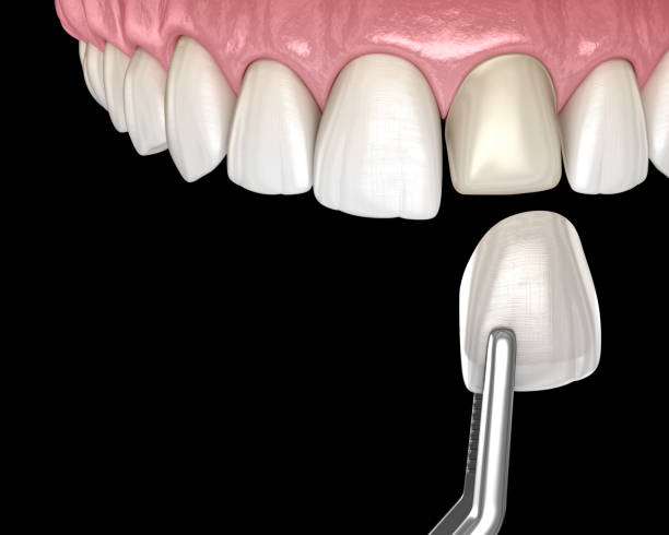 Brighten Your Smile with Dental Veneers in Islamabad