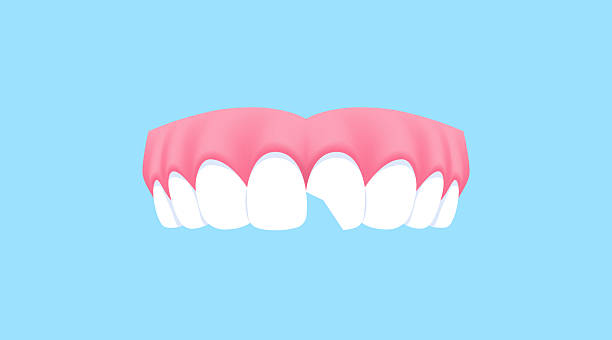 Advanced Care for Broken Teeth: Tooth Fracture Treatment in Islamabad