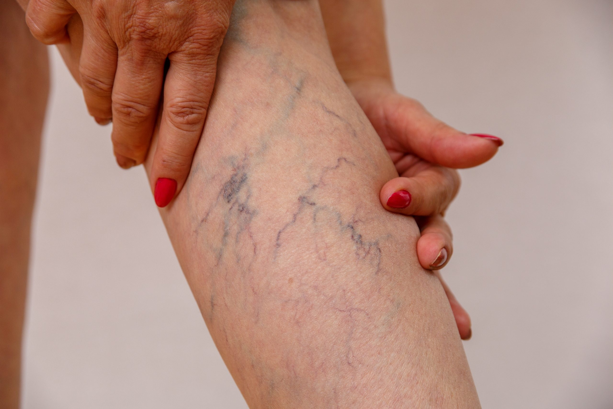 What Does a Vein Clinic Do for Patients with Vein Problems?