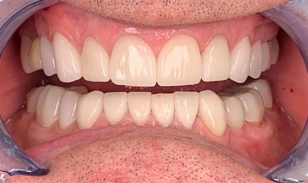 When Should You Visit a Dentist for a Wisdom Tooth Emergency?