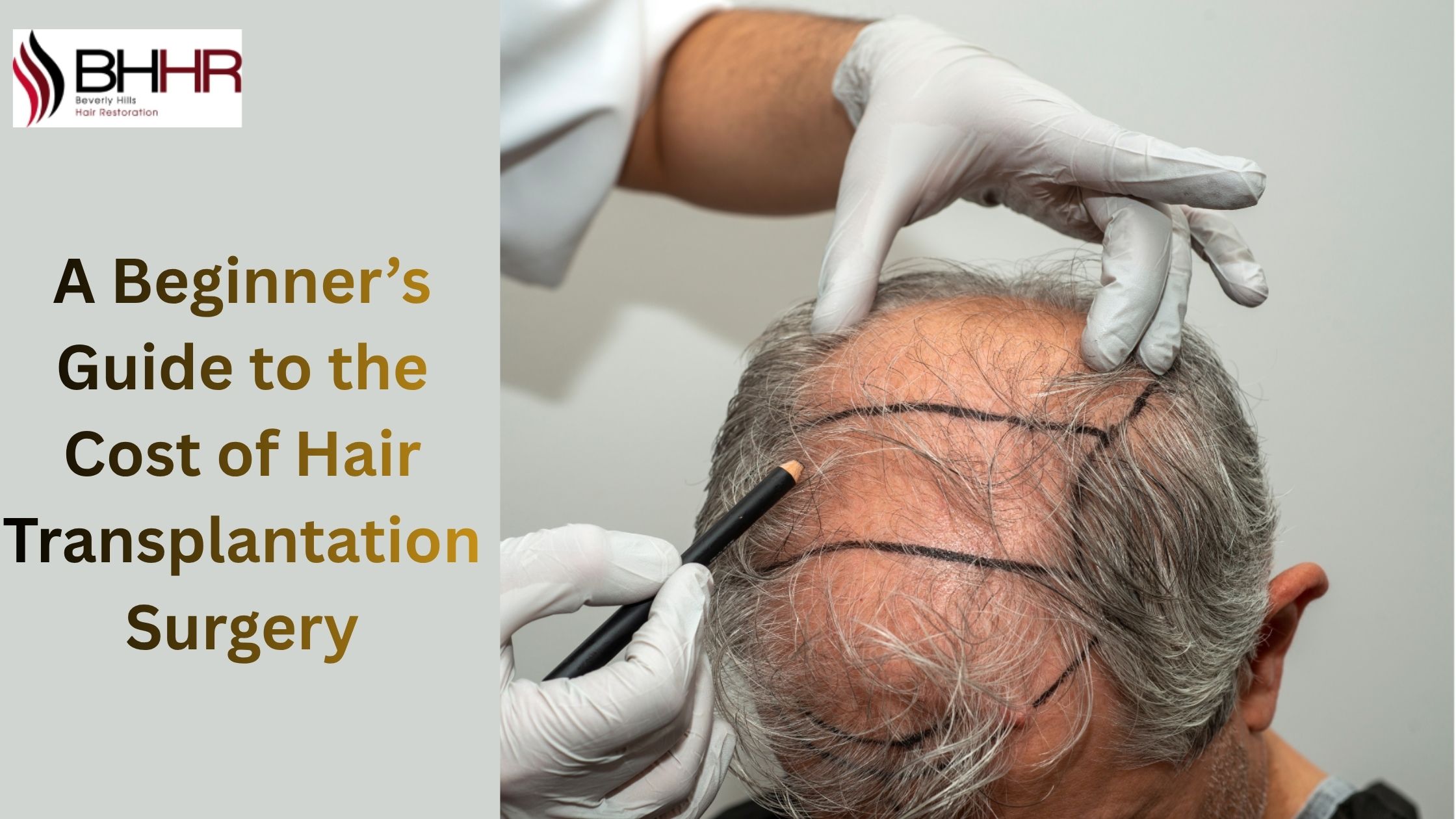 A Beginner’s Guide to the Cost of Hair Transplantation Surgery
