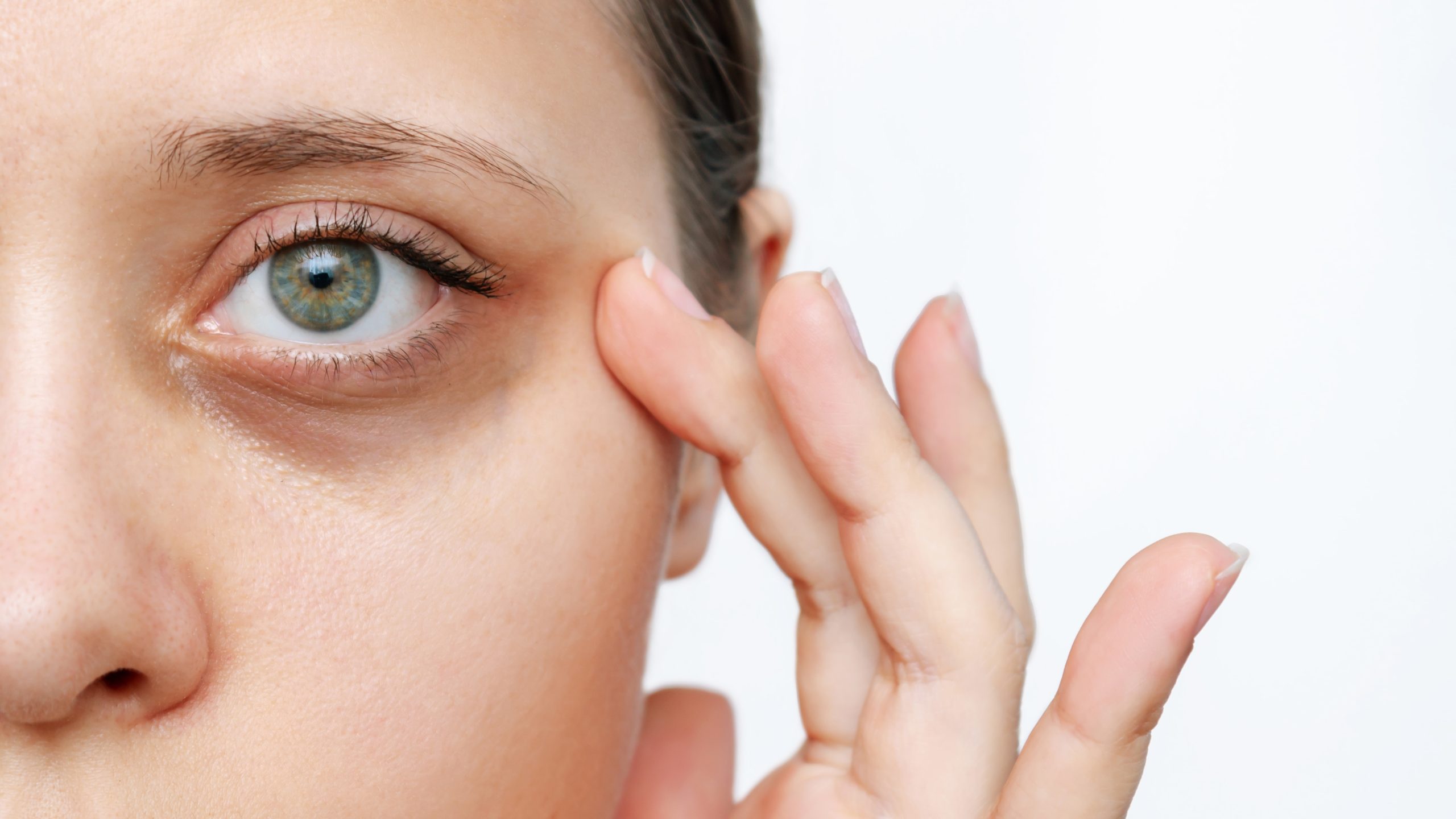Laser Treatment for Dark Circles in Islamabad – Is It Worth It?