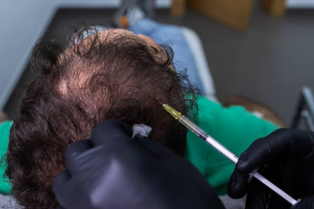 PRP Hair Treatment in Islamabad – Natural Solution for Hair Loss