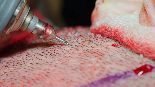 FUE Hair Transplant in Islamabad – Advanced Hair Restoration for Natural Results