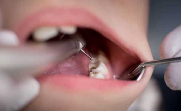 Painless Dental Fillings in Islamabad for Stronger Teeth