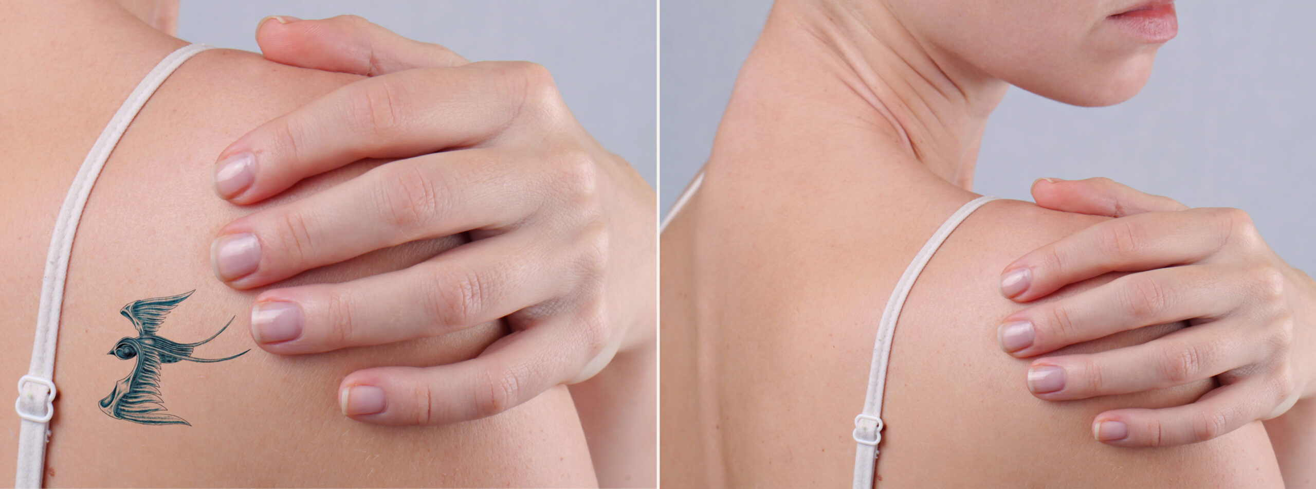 tattoo removal dubai
