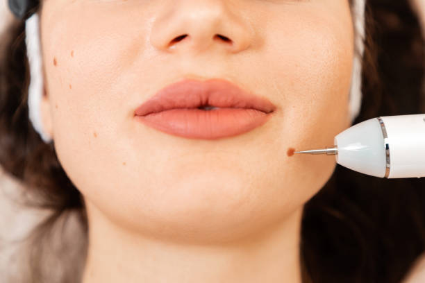 Birthmark Removal in Islamabad Using Cutting-Edge Laser Technology