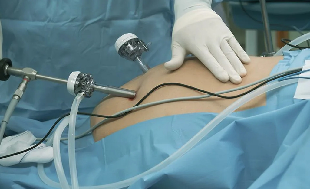 Why Choose Laparoscopic Surgery in Islamabad for Faster Recovery